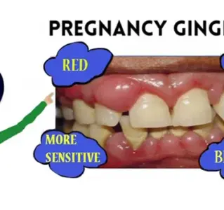 Home Remedies for Swollen Gums During Pregnancy | Most Effective